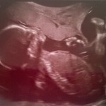 20 week scan, and it’s a ….